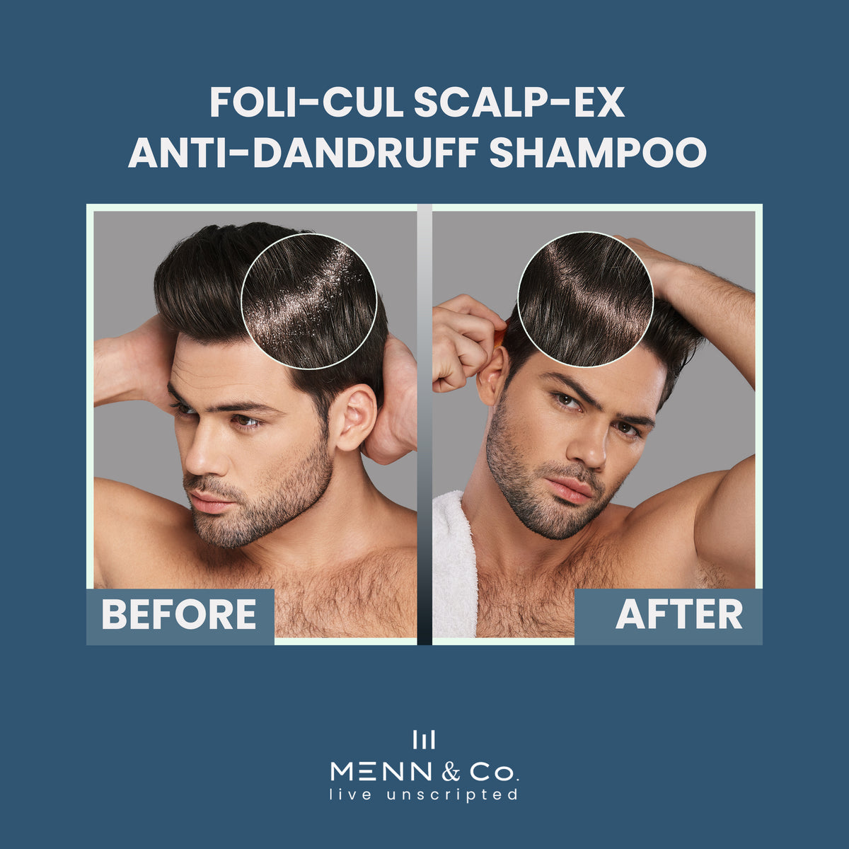 Before and after effect of Foli-Cul Scalp-Ex Anti-Dandruff Shampoo on a man's scalp with Menn & Co branding.